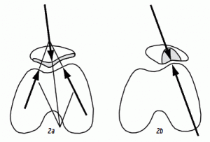 Normal knee alignment versus lateral knee "tracking"